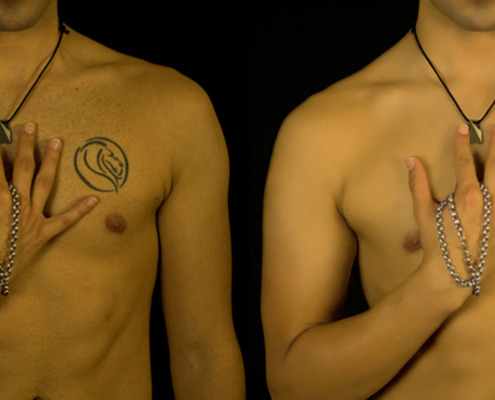 Tattoo Removal Before & After - Photo Edit